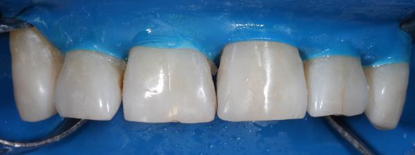 Лечение передних зубов при помощи компомерных пломб стало