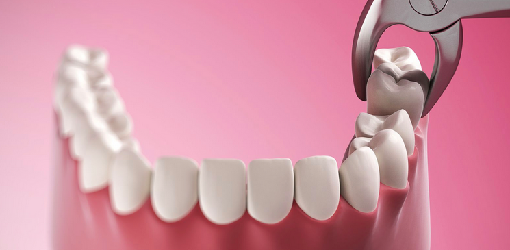 Удаление и лечение зубов с наркозом
