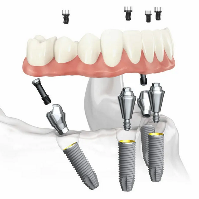 Имплантация зубов под седацией