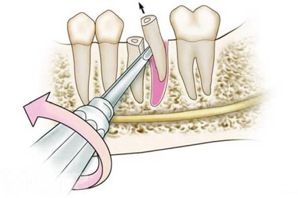Операция по удалению корня зуба