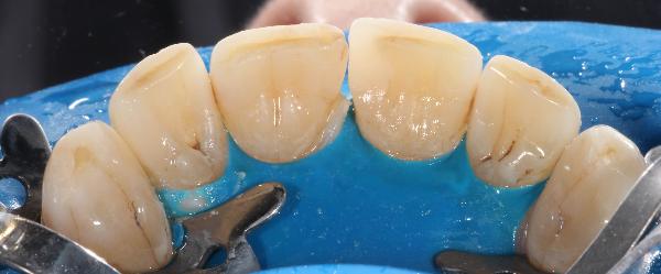 Лечение передних зубов при помощи компомерных пломб было
