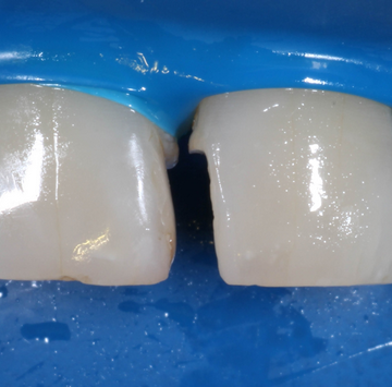 Лечение передних зубов при помощи компомерных пломб