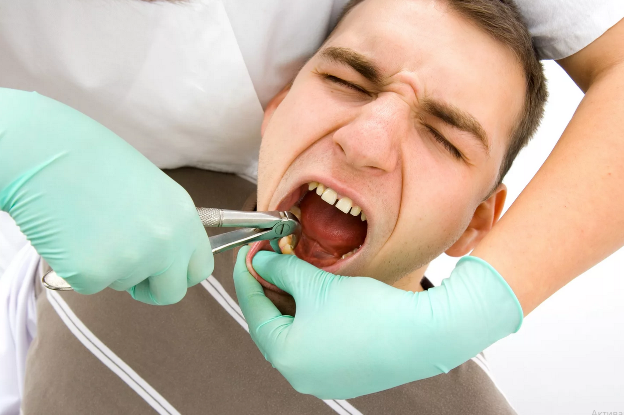 Удаление зубов с седацией