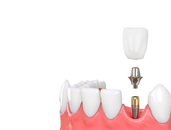 Все зубы 1 день 12 - Плюсы и минусы восстановления
